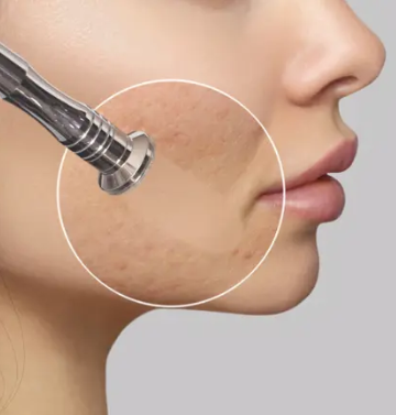 ¿Qué es la microdermoabrasión y para qué sirve?